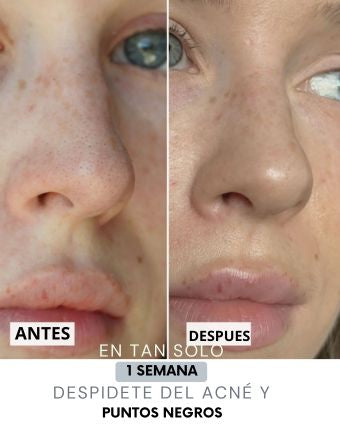 Parches avanzados para puntos negros
